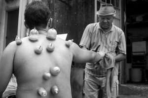 Cure Cupping